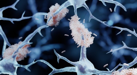 The accumulation of amyloid plaques in the brain is what causes dementia.