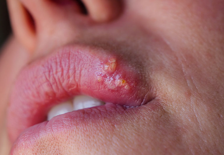 Herpes can take the form of cold-sores.